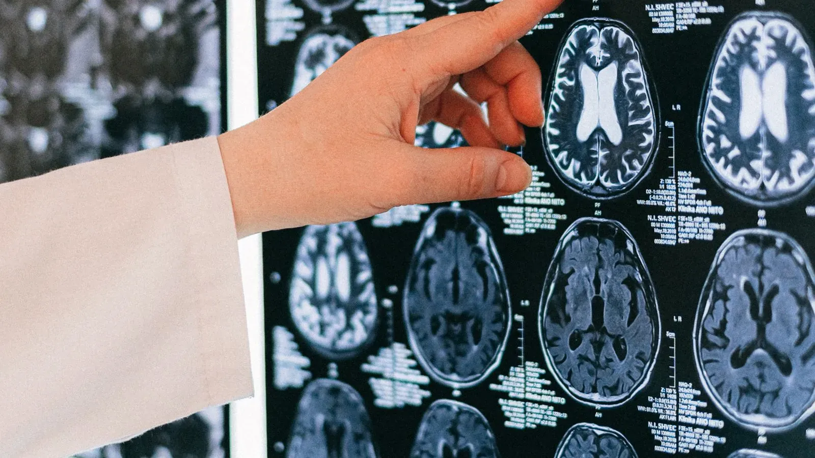 Cómo anonimizar historiales clínicos para investigación médica según el RGPD